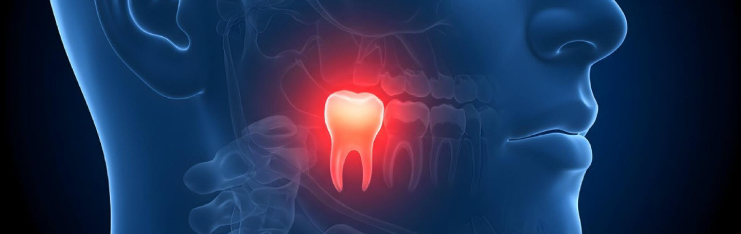 Воспаление десны вокруг зуба мудрости: причины и лечение