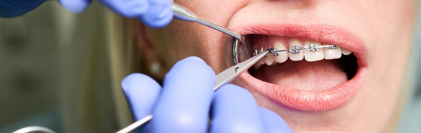 Можно ли ставить брекеты при пародонтозе?
