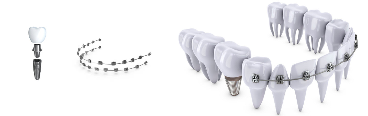 Имплантация зубов и проблемы с прикусом: как это связано?