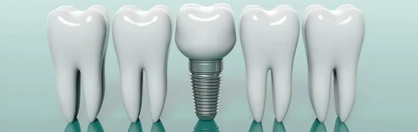 Имплантация зубов: просто о сложном