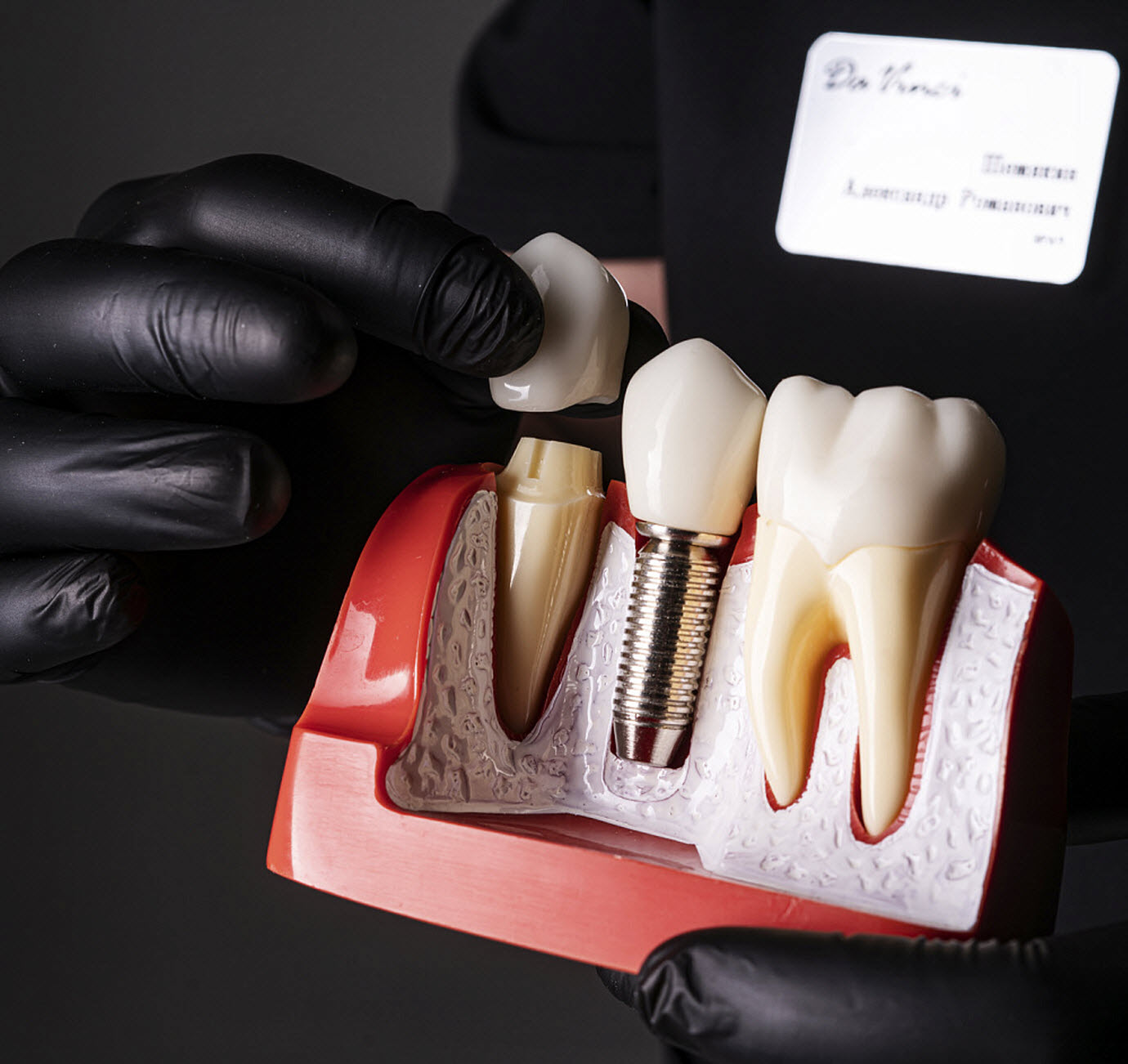 Имплантация зубов — создаем улыбки, меняющие жизни