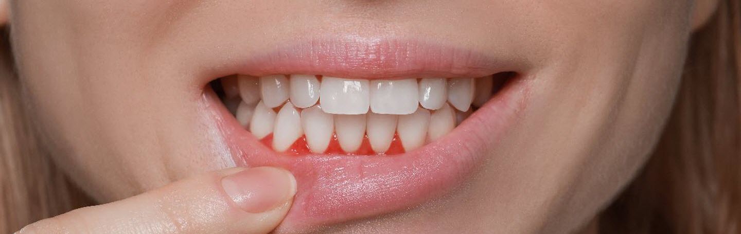 Почему кровоточат десны и что с этим делать?