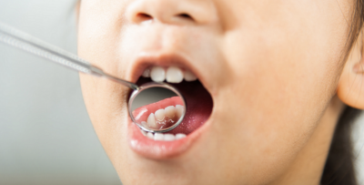 Риски для зубов у особенных детей