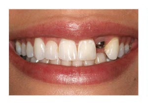 Установка импланта, если отсутствует 1 зуб