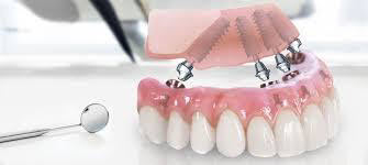 Альтернатива зубным протезам