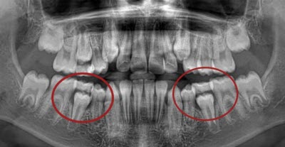Рентген зубов это не опасно