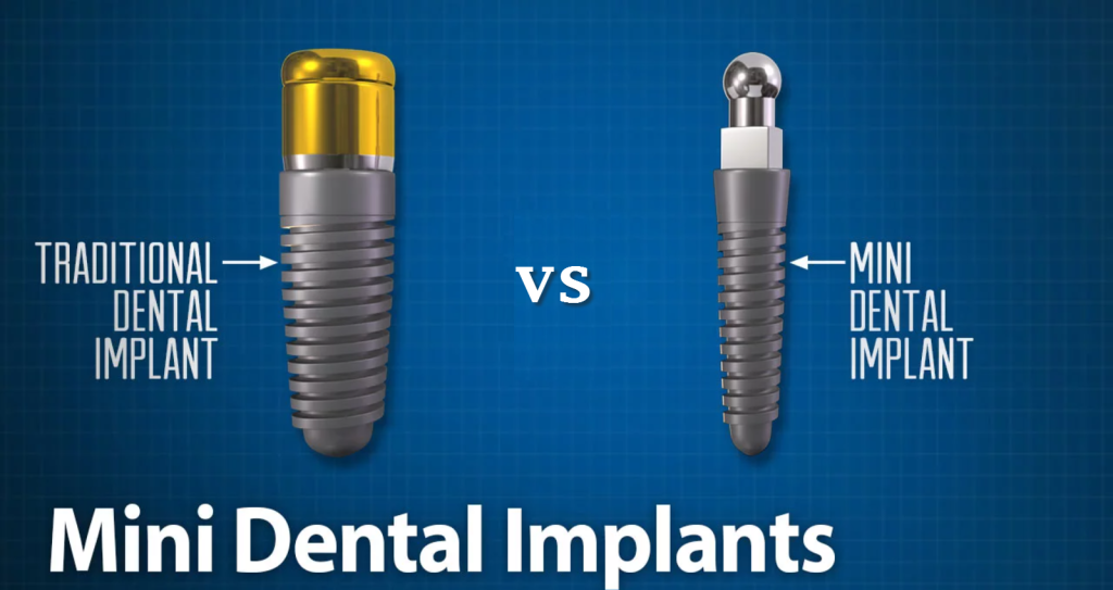 Что такое мини-импланты для зубов